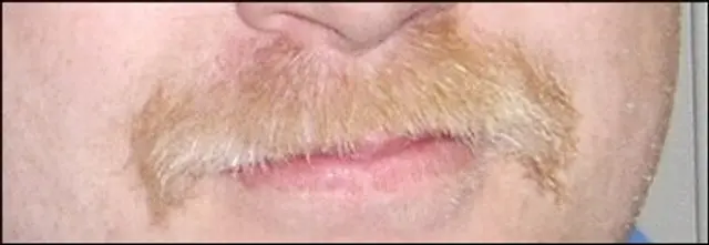 Kampen mot mustaschen